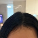 YOLO헤어샵 | 퀄라이프 탈모토닉 사용 후기 두피 열감소 루틴 정수리 변화