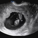 내가 가장 예뻤을때(평일) | [임신3개월]임신9주차, 정기검진! (임신3개월 입덧/증상/영양제 등)