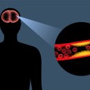 뇌혈관 막힌 '뇌경색' 건강보험 진료비 30% 급증 이미지
