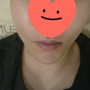 차케바라커피혁명 | 청담피부과 티타늄리프팅 리투오 리타늄 내돈내산 후기