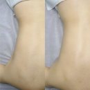 디톡스 | 사당 등여드름 모공각화증 스킨리알 바디디톡스 후기
