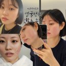 얼굴탄력 리프팅으로 선택한 노원역 피부과추천 얼굴 전체 인모드 후기