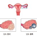 난소암(Ovarian cancer) 이미지