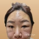 압구정 필러 비티에프의원 이마필러 맞고 온 후기예요!