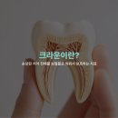 덴아트치과기공소 | 크라운, 어떤 치료인지 정확하게 알고 계신가요? | 신사역 디앙치과