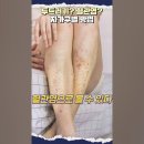 다리에 생긴 붉은 점, 방치하지 말고 치료해야 한다?! 이미지