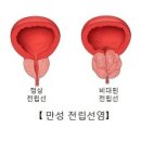만성 전립선염 (Chronic prostatitis) 이미지