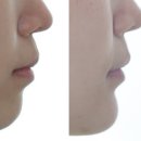 고려에스라인의원 | 설측교정 비발치 무턱 돌출 개선 후기. 콤비교정 비용과 고려할점