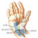 손저림증， ‘양손들기 자가진단법’ 으로 쉽게 진단 이미지