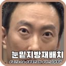 더서울병원 | [눈밑지방재배치] 중년 하안검 수술 서울 병원투어 후기