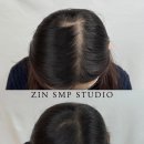 JIN STUDIO | [웨딩관리] 홍대 두피문신 노광고 찐 후기(JIN SMP STUDIO)