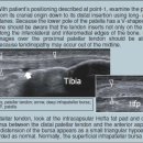 근골격계sono자료 Patellar tendon 이미지