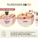 압구정라인성형외과의원 | 압구정성형외과 엑소젠 눈꺼풀 리프팅 후기