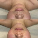 청주 윤곽관리 ｜'더리파인' 턱선 탄력 제대로 잡은 하이핏 후기