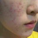 이경규한의원 | 여드름피부과 다니고 치료 부작용까지 겪어봤다