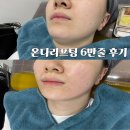 주식회사 다온다옴 | 의정부피부과 온다 리프팅 6만줄 후기