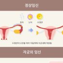 자궁외임신 증상 및 원인과 수술 : 통증 임테기 이미지