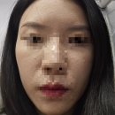 규창이네 | 노원 피부관리 승무원 합격을 도와 준 수디끌스킨, 좁쌀여드름 물방울 리프팅 강추