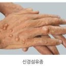 피부섬유종 신경섬유종 증상 원인 낫는법 이미지