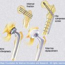 Hip fracture 이미지