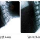 [디스크｜목디스크] - 목디스크의 원인과 증상 이미지