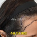 중앙헤어라인 이미지