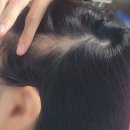 영등동-08 | 여자 원형탈모 재발 일기｜두려움은 줄었지만, 마음은 여전히 복잡하다