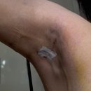 담소유병원 | 담소유병원 부유방 수술 후기1 (수술당일~2주차)