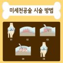 MM Gym | [장안동 운동재활] 미세천공술(Micro Fracture) 수술 &amp; 재활 운동