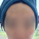 연세제일의원 | 합정 연세보드미 의원 편사제거 후 일주일 후기 (정보공유 O)