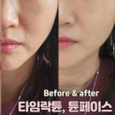 타임락 | 튠페이스 튠라이너 타임락튠 리프팅 내돈내산 3회차 후기