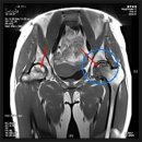 [인공관절수술잘하는곳] 대퇴골두무혈성괴사로 고관절인공관절수술 후 관리가 중요해요 이미지