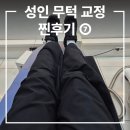 상봉동틀이치과의원 | 성인무턱교정 후기 ⑦, 무턱수술 아닌 치료 후기, 장치 부착 28주차