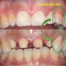 한길치과기공소 | 앞니에 잇몸염증과 충치가 심해요. 앞니 지르코니아 크라운 성공 후기. 치료과정/치료기간/비용/전후비교.