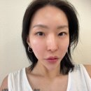 신사엘성형외과의원 | 신사역성형외과 맥스모드리프팅 인모드 팔자주름리프팅 효과 후기
