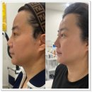 온천장역 3번출구 주변 | 볼패임 이중턱개선 티리온X 온다리프팅 "아미뷰티센터" 내돈내산 재방문 후기