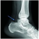 용인우리정형외과의원 | [용인 보정동 정형외과] 아킬레스건 파열, 증상부터 치료까지