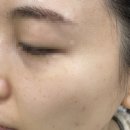 스위스의원 | [수원_피부과] 스위스의원 비립종,편사,흑자 루비레이저 후기