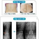 척추 전방전위증 의미와 운동치료법 및 척추유합술과 척추유합술 수술 후 관리방법﻿ 이미지