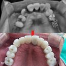 박준치과의원 | 전체임플란트비용 및 후기 (잇몸에 뼈가 없어도 가능합니다)