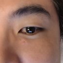 2년간 스트레스였던 왕점빼기(DS피부과 점제거 시술후기)!!