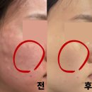 피부관리사 (주간) | 청담피부과 포텐리쥬베룩 효과 가격 2주차 후기