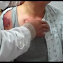 극상근 건 부분파열 supraspinatus partial rupture 치료 사례 이미지