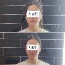 흥덕중앙로 4 | 용인피부관리 리저브미, 아프지않은 윤곽관리 JH윤곽술 후기