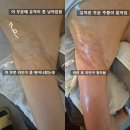 CU 행신1호점 | [행신동 꿀벌스킨앤바디] 지방흡입후관리하러/ 행신피부관리/ 행신마사지