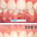 잇몸염증 , 치근활택술 & 치주소파술 (치석 제거) 이미지