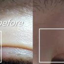 셀프케어약국 | 비립종 제거 후 셀프 케어 후기