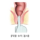 ﻿항문소양증 이미지