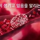 혈전이 생기고 있음을 알리는 신호 이미지