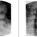 식도 조영검사[esophagography] 이미지